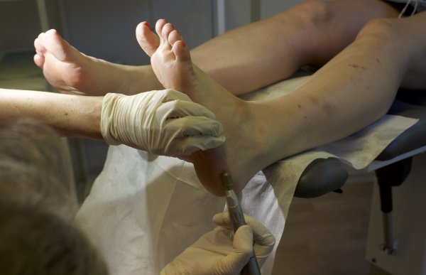 En person med hvite hansker fjerner gammel hud fra føtter til en annen person.